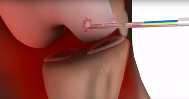 Injecteerbare kraakbeenpleister